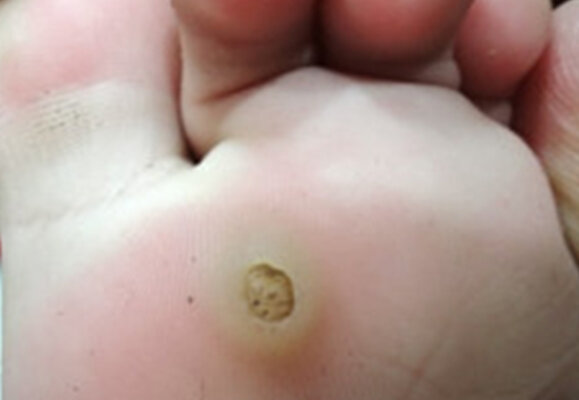 Plantar Warts