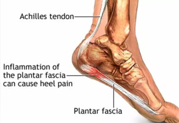Plantar Fasciitis – Heel Pain (Heel Spur)