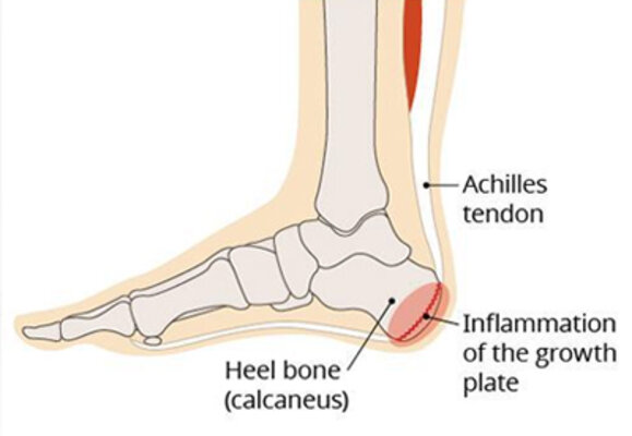 Duplicate Sever’s Disease (Calcaneal Apophysitis)