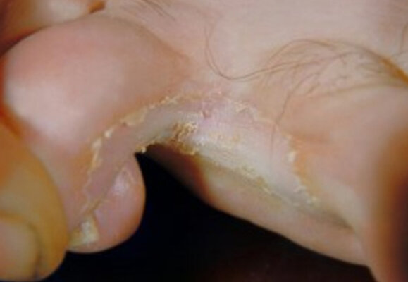 Tinea | Common Foot Problems