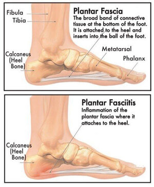 Plantar Fasciitis  What is it and What Causes Plantar Fascia Pain?