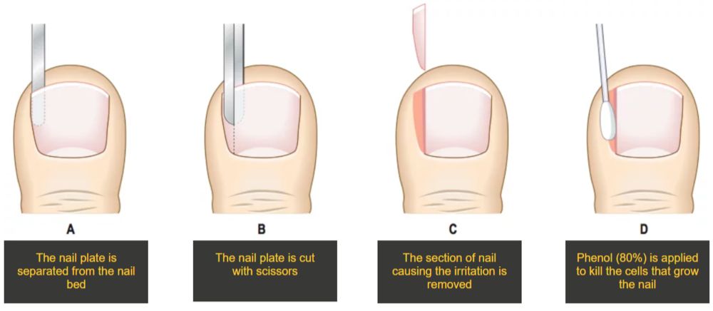 Ingrown nail treatment and surgery | South West Podiatry
