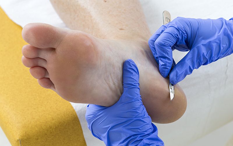 Cracked Heels & Common Foot Problems | South West Podiatry